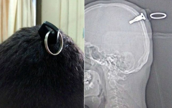 Hy hữu: Bị cắm thẳng chìa khóa vào đầu sâu 5 cm Ảnh 2