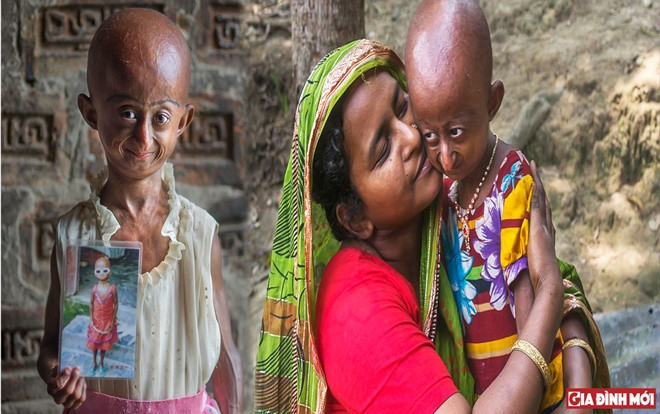 Bé gái bị chế giễu là 'người ngoài hành tinh' vì khuôn mặt lão hoá Ảnh 2