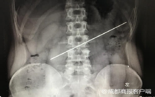 Nuốt thanh thép gần 20 cm vì cá cược 18 triệu đồng và cái giá đắt Ảnh 2