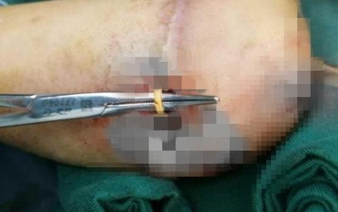 Kinh hãi dây chun đeo lâu ngày ăn sâu vào da tay bé gái Ảnh 2