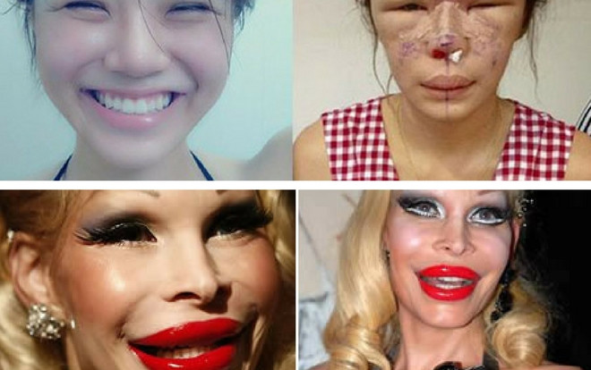 Xem clip này xong đảm bảo nhiều chị em không dám đi tiêm filler để mặt sáng, cằm thon nữa Ảnh 2