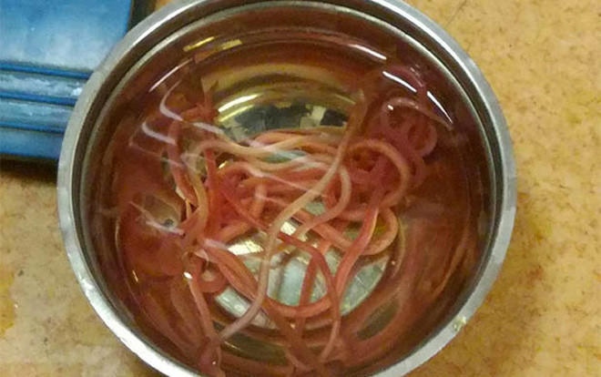 Bác sĩ tá hỏa khi lấy ra 14 con giun còn ngoe nguẩy từ ống mật bệnh nhân Ảnh 2