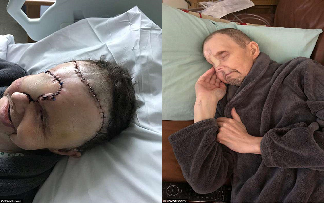 Người đàn ông hóa ‘quái vật’ vì bị căn bệnh ung thư mắt hành hạ Ảnh 2