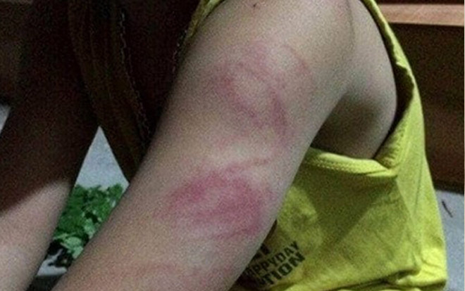 Học sinh lớp 1 bị đánh bầm tím tay vì không đọc thông viết thạo Ảnh 2