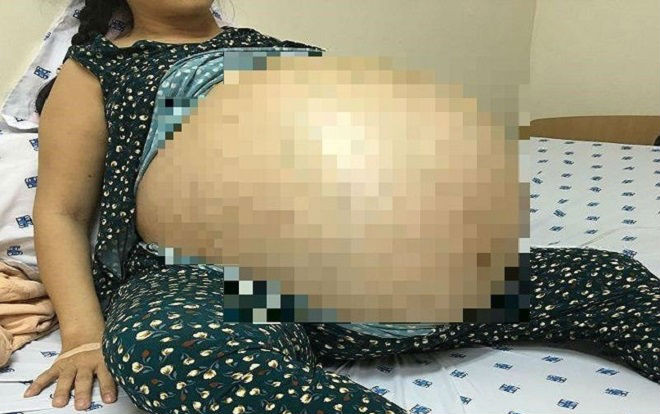 Người phụ nữ mang khối u 50kg lớn nhất Việt Nam Ảnh 2