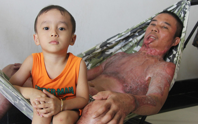 Bị điện giật cháy người không có tiền chạy chữa, bố xót xa nhìn con trai 4 tuổi không nhận ra mình Ảnh 2