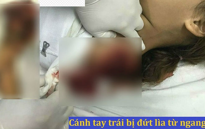 Chơi trốn tìm cùng bạn, bé gái bị máy cưa cắt đứt lìa cánh tay trái vĩnh viễn Ảnh 2