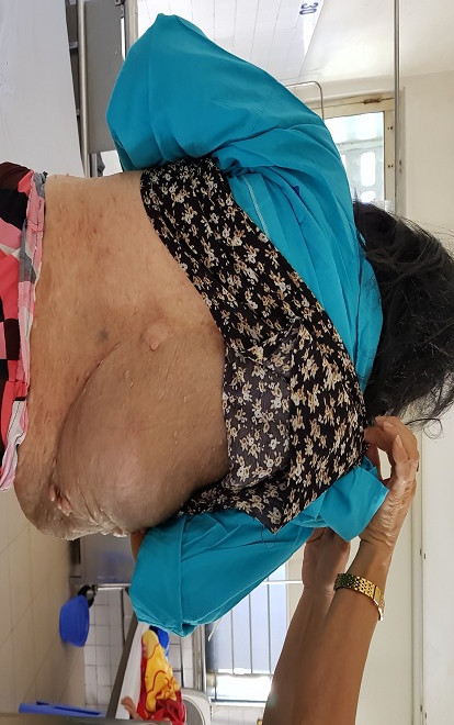 Sốc: Người phụ nữ mang 2 khối u khổng lồ hơn 10kg trong người suốt nhiều năm Ảnh 2