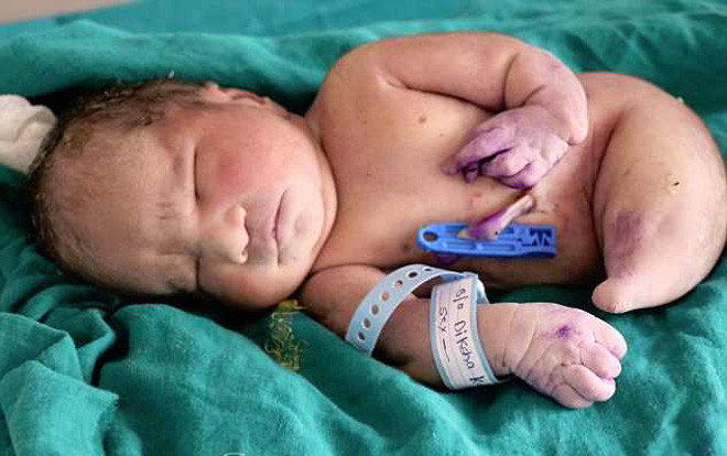 Bé sơ sinh mắc hội chứng 'nàng tiên cá' chào thế giới 15 phút thì qua đời Ảnh 2
