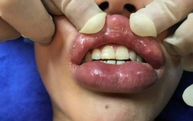 Cô gái trẻ bị phù nề sưng tấy, đau nhức vùng mắt và môi sau khi tiêm filler Ảnh 2