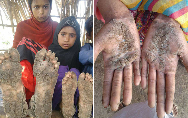 4 đứa trẻ trong một nhà 'hóa đá' vì bệnh da hiếm gặp Ảnh 2