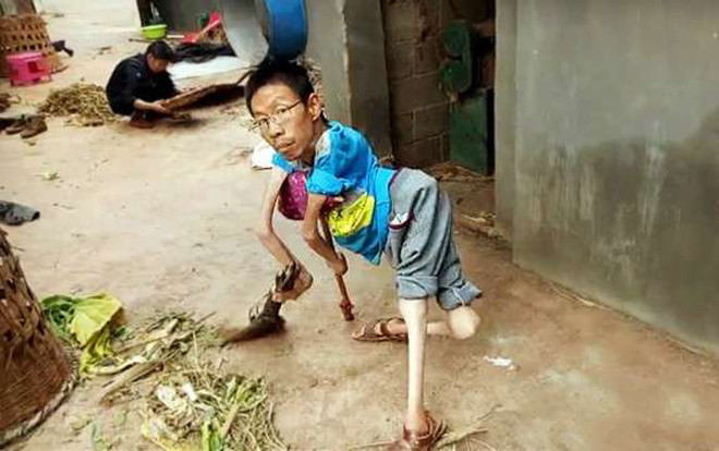 Nghị lực của người đàn ông mất cả chân lẫn tay khiến nhiều người phải cúi đầu xấu hổ Ảnh 2