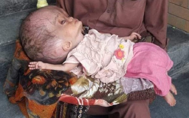 Đầu bé gái 7 tháng tuổi to như quả bóng vì chứa 'chất dịch chết người' Ảnh 2