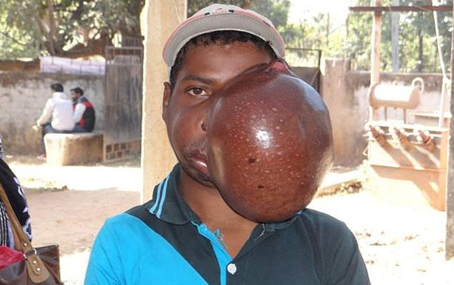 Khối u to bằng quả bóng che nửa khuôn mặt chàng trai 19 tuổi Ảnh 2
