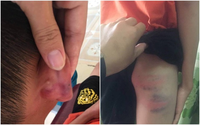 Nghi vấn nam sinh 12 tuổi bị mẹ kế đánh đập gây thương tích nặng phải nhập viện Ảnh 2