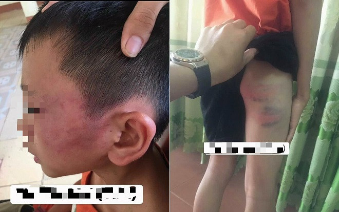 Bé trai 12 tuổi nghi bị mẹ kế đánh nhập viện ở Nghệ An: Mẹ kế là giáo viên, 'do bé ăn nói hỗn láo nên mới dạy' Ảnh 2