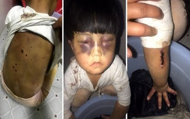 Bé 4 tuổi ở Trung Quốc bị cha đánh thâm tím mặt, ép giặt quần áo Ảnh 2