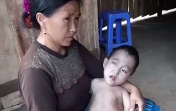 Cảnh khốn cùng của gia đình dân tộc H’Mông có 3 chị em bị bệnh hiểm nghèo bị đồn do hôn nhân cận huyết Ảnh 2