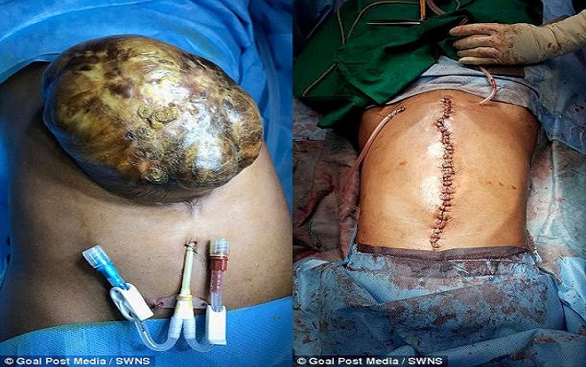 Thiếu nữ mang 'túi nội tạng' khổng lồ ngoài khoang bụng Ảnh 2