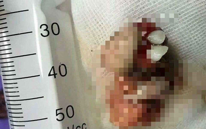 Khối u mọc răng trong buồng trứng bé gái 12 tuổi Ảnh 2