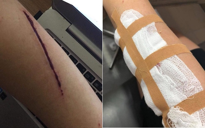 Buồn chuyện gia đình, thiếu nữ tự rạch tay bằng dao lam rồi bịa chuyện bị cướp túi xách Ảnh 2