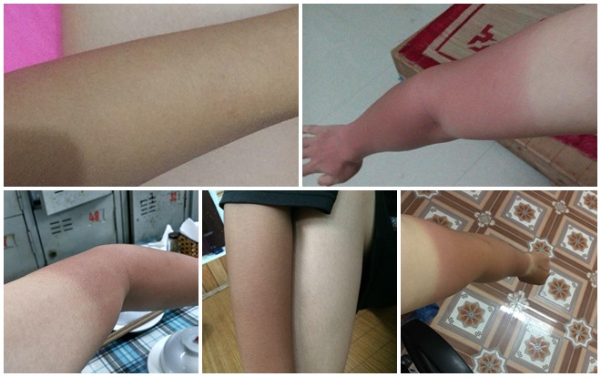 Dùng bìa carton chống nóng vẫn không ăn thua, dân mạng bất lực chia sẻ ảnh làn da 'hai màu' vì cháy nắng Ảnh 2