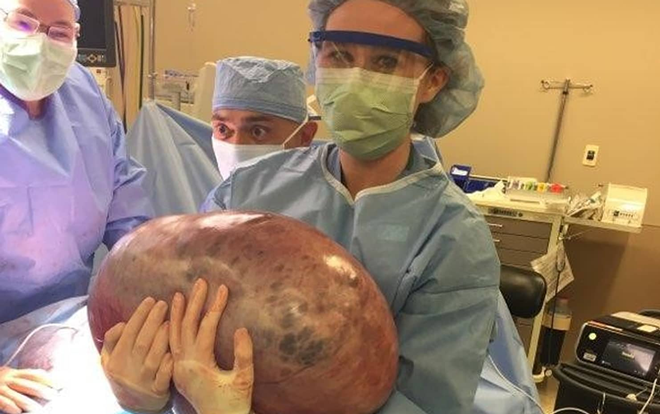 U nang to như quả dưa hấu khổng lồ bên trong buồng trứng của người phụ nữ Ảnh 2