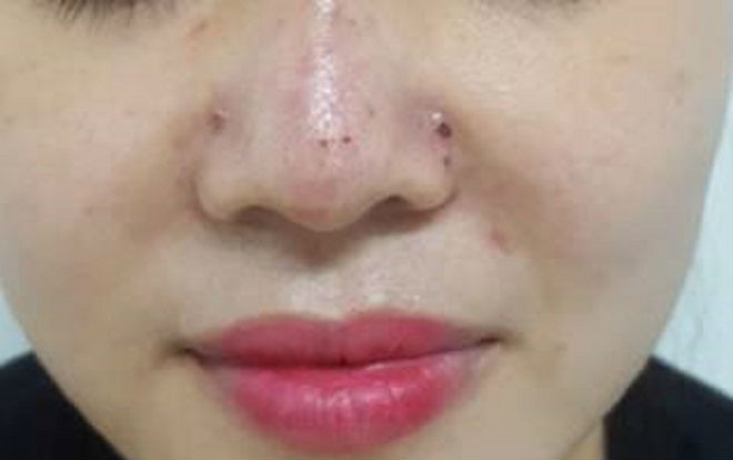 Thêm một người phụ nữ bị biến dạng mũi vì tiêm chất làm đầy Ảnh 2