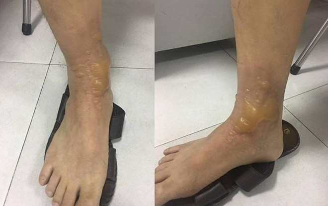 Đi massage, quý ông bị bỏng nặng phải nhập viện Ảnh 2