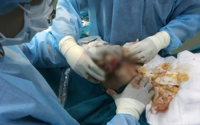 Phẫu thuật thẩm mỹ ở Thái Lan, nữ Việt kiều phải rút cả lít hóa chất lạ ở ngực Ảnh 2