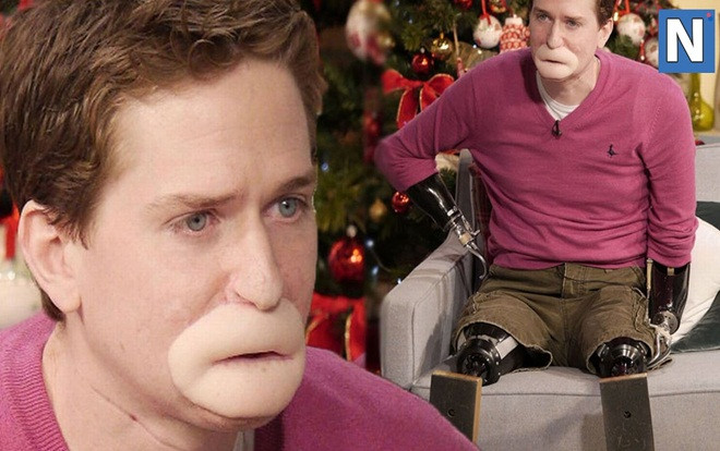 'Ngả mũ thán phục' nghị lực sống phi thường của người đàn ông bị cụt tứ chi Ảnh 2