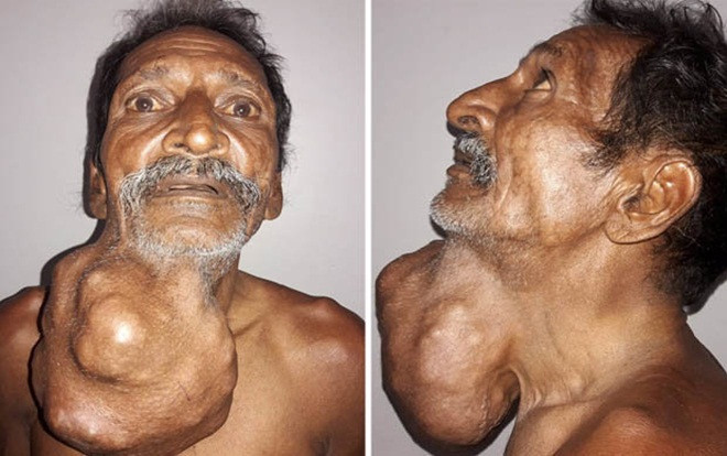 Giật mình trước khối u 'khổng lồ' dưới hàm người đàn ông suốt 20 năm Ảnh 2
