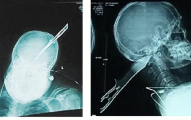 Bị dao đâm xuyên đầu, người đàn ông vẫn bình tĩnh lái xe đến đồn cảnh sát Ảnh 2