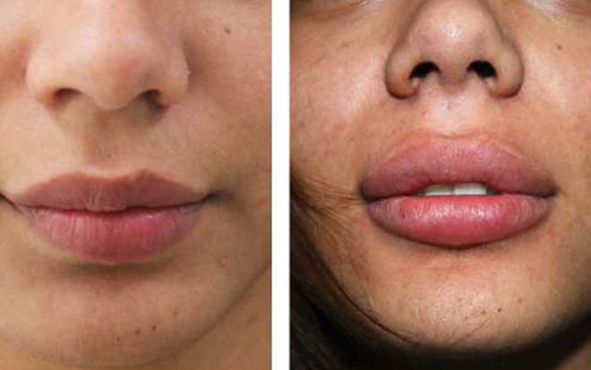 Kinh hoàng làm đẹp bằng filler Ảnh 2