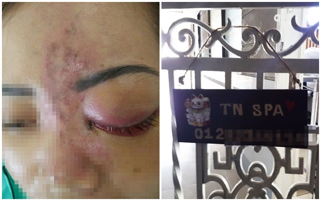 Tiêm filler nâng mũi ở spa không có giấy phép hoạt động, nữ khách hàng đau đớn vì bị mù mắt trái Ảnh 2