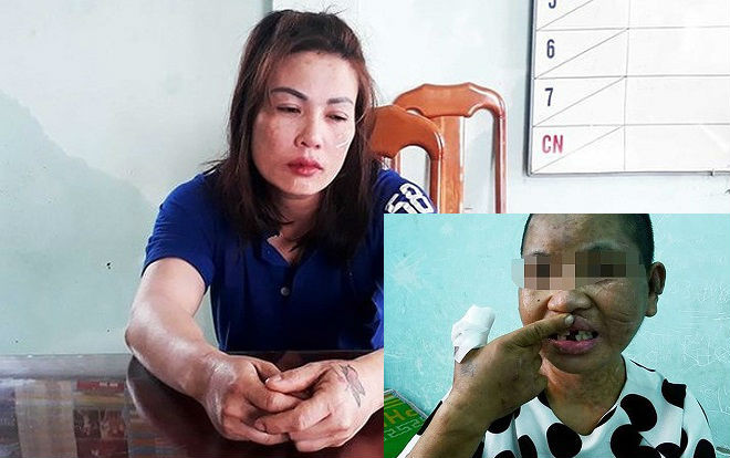 Khởi tố vụ án, bắt tạm giam nữ chủ nhà tra tấn dã man giúp việc như thời trung cổ Ảnh 2