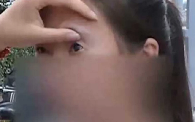 Hậu phẫu thuật cắt mí, cô gái không còn nhìn rõ mọi vật Ảnh 2