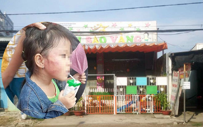 Bé gái 5 tuổi bị bảo mẫu tát mạnh nhiều cái gây nứt xương hàm Ảnh 2