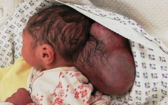 'Cậu bé hai đầu' sống sót kỳ diệu sau ca phẫu thuật nguy hiểm Ảnh 2