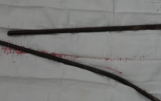 Tai nạn kinh hoàng: Ngã từ công trường trên cao xuống, người đàn ông bị hai thanh sắt đâm xuyên háng Ảnh 2