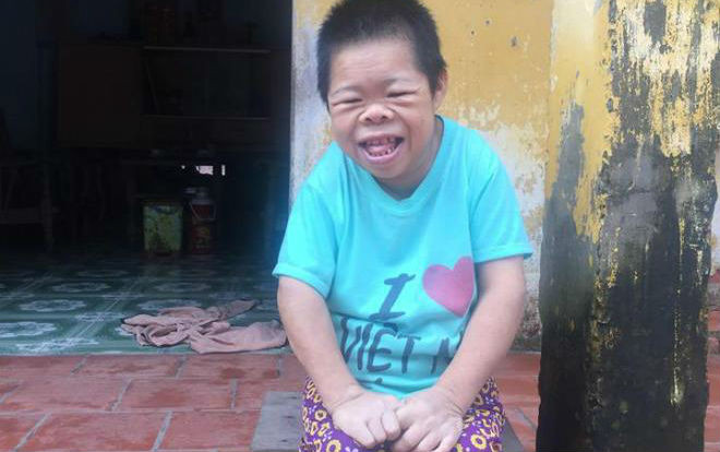 'Cô gái Sọ Dừa' mang hình hài trẻ 4 tuổi: Người mẹ vẫn chờ đợi, con cứ mãi ngây ngô Ảnh 2