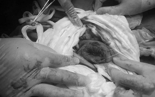 Cứu sản phụ vỡ tử cung khi mang thai 37 tuần tuổi Ảnh 2