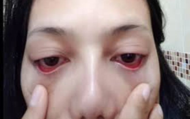 Cô gái 'khóc ròng' vì trụi sạch lông mi sau khi tới thẩm mỹ viện Ảnh 2