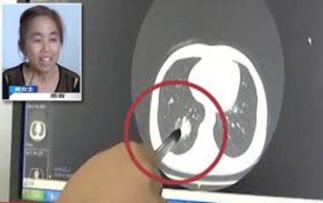 Tá hỏa phát hiện nắp bút kẹt trong phổi suốt 40 năm mà không hề biết Ảnh 2