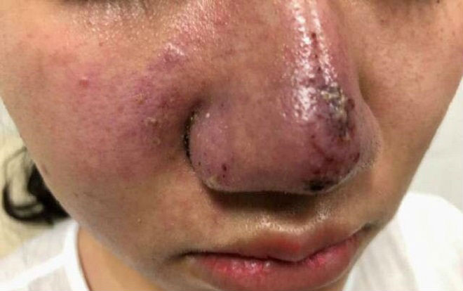 Tiêm filler làm đẹp, cô gái trẻ ở Hà Nội bị méo cằm, lệch má Ảnh 2