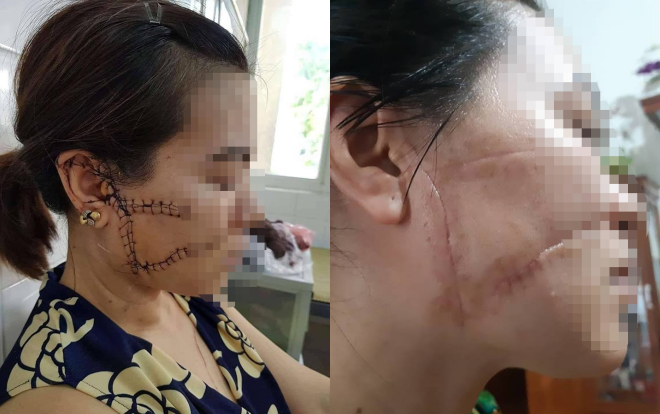 Nỗi đắng cay tủi nhục của người vợ bị chồng cầm dao rạch mặt, cắt gân chân vì nổi cơn cuồng ghen Ảnh 2