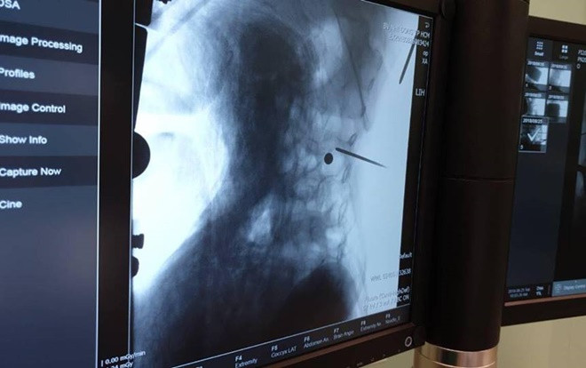 Nghịch súng hơi tự chế, bé trai 5 tuổi bị đạn xuyên thủng lưng Ảnh 2