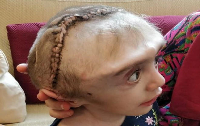 Cô bé 2 tuổi có đầu to như quả bóng bất động Ảnh 2