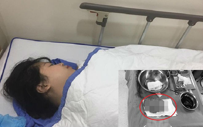 Hình ảnh ca phẫu thuật thu nhỏ ngực của nữ sinh Hải Dương, bác sĩ mổ lấy đi hơn 1kg mỡ mỗi bên Ảnh 2