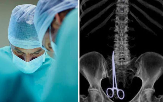 Bác sĩ để quên kéo phẫu thuật dài 15 cm trong người bệnh nhân suốt 6 tháng Ảnh 2